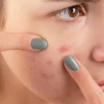 Trik Jerawat Hormonal Biar Hasilnya Maksimal Tanpa Ribet